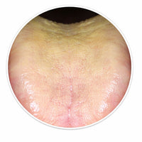 Rotten tongue coating