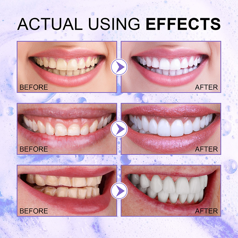 orabus™ Purple Whitening Toothpaste | With just one brushing, effortlessly neutralize yellow teeth and reveal a bright, white smile.